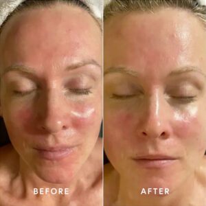 Before and AFter epicutis lipid recovery mask