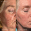 Epicutis Oil Cleanser Before and After