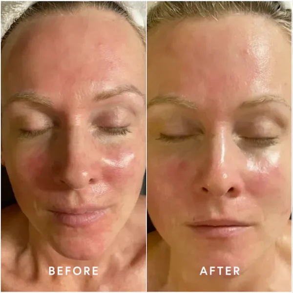 Before and After using Epicutis Oil Cleanser