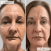 Omnilux Contour Face - before and after