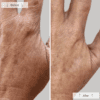 Omnilux Contour Glove - before and after