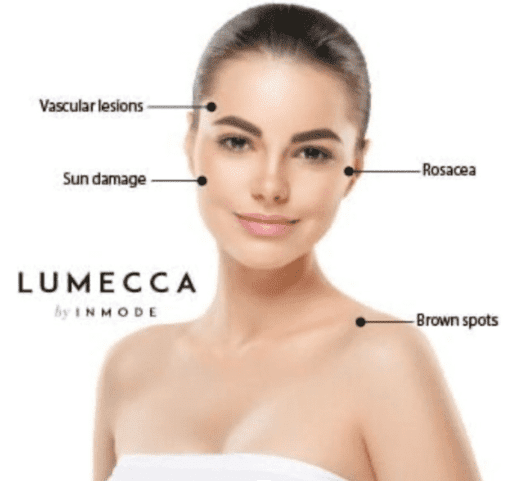 IPL (Intense Pulsed Light) - Knoxville