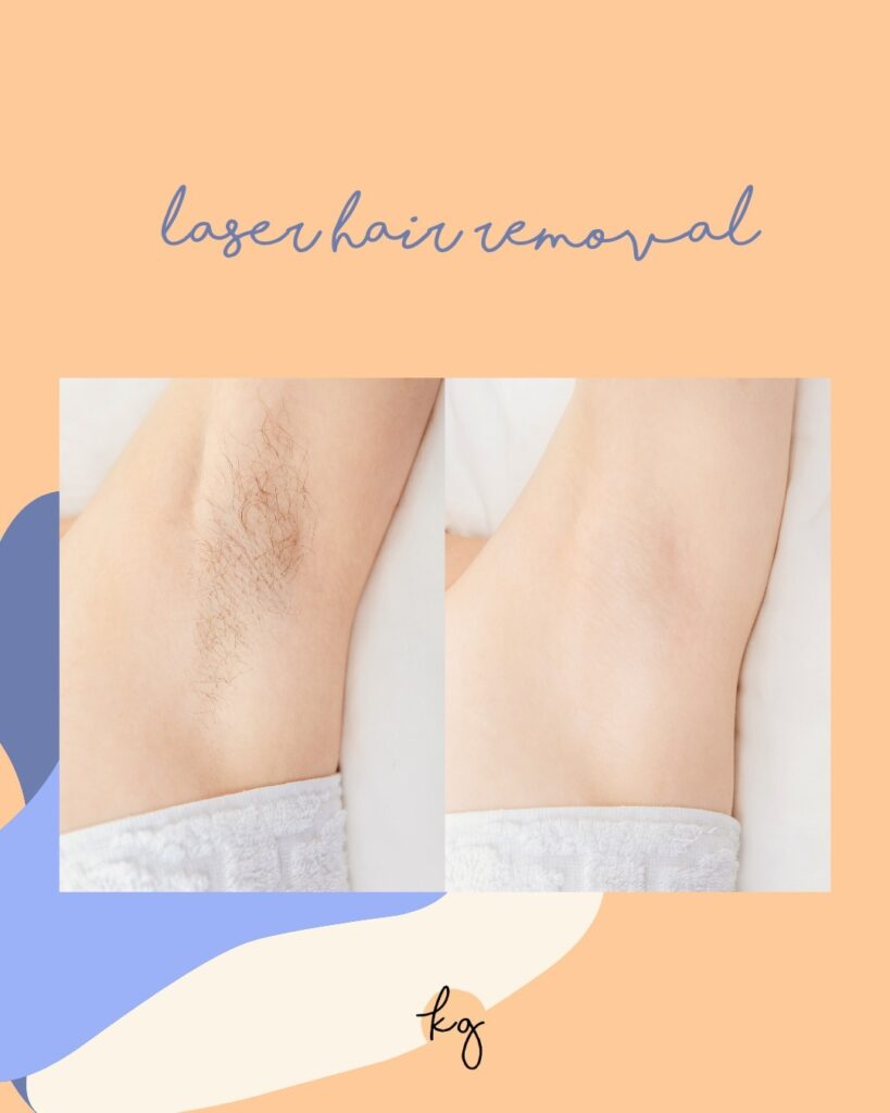 laser hair removal knoxville tn