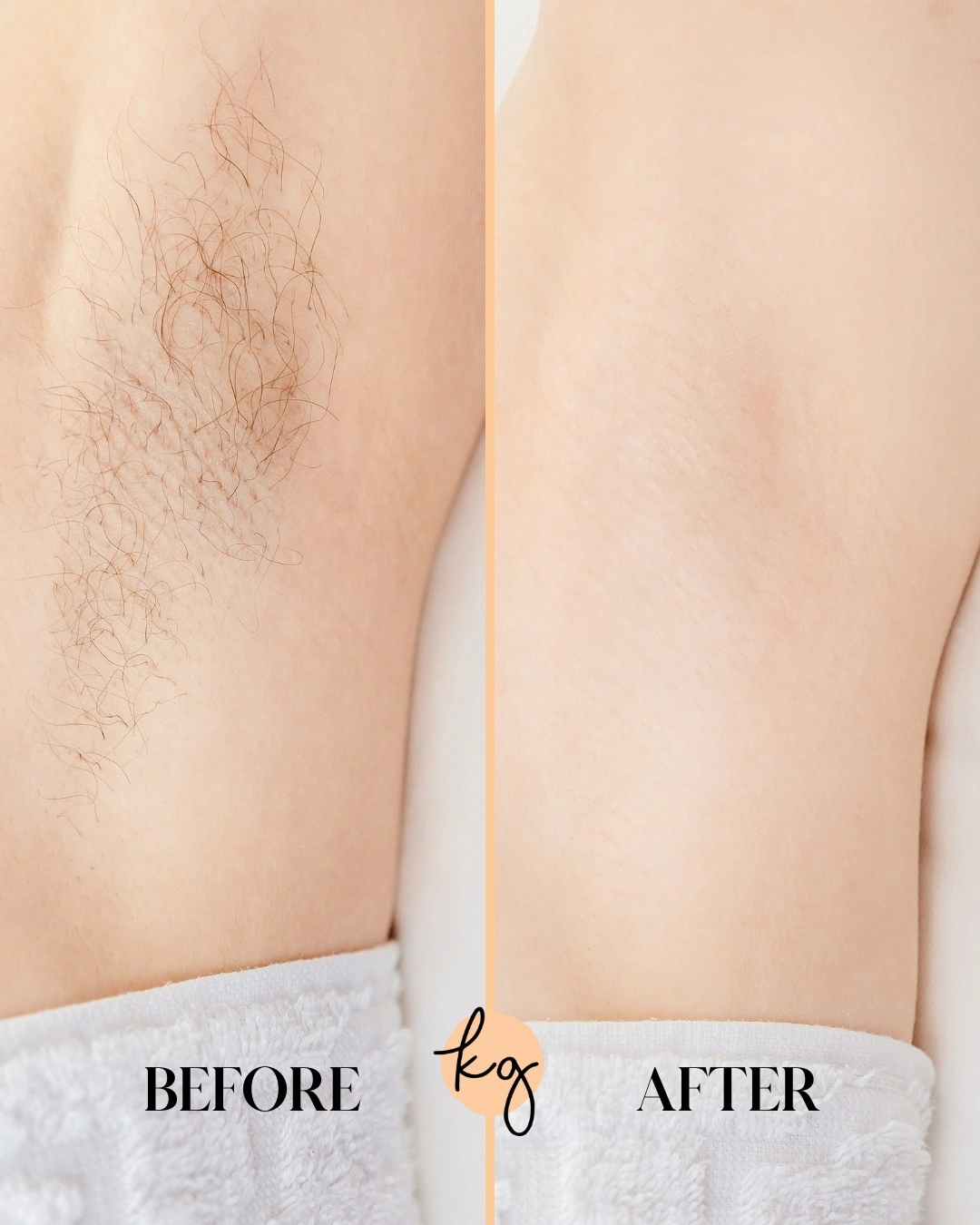 Diolaze laser hair removal before and after - knoxville tn