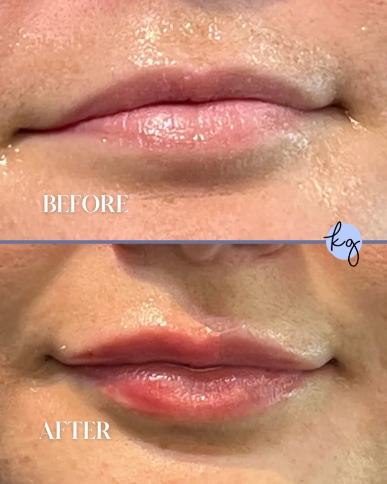 lip filler before and after - knoxville tn