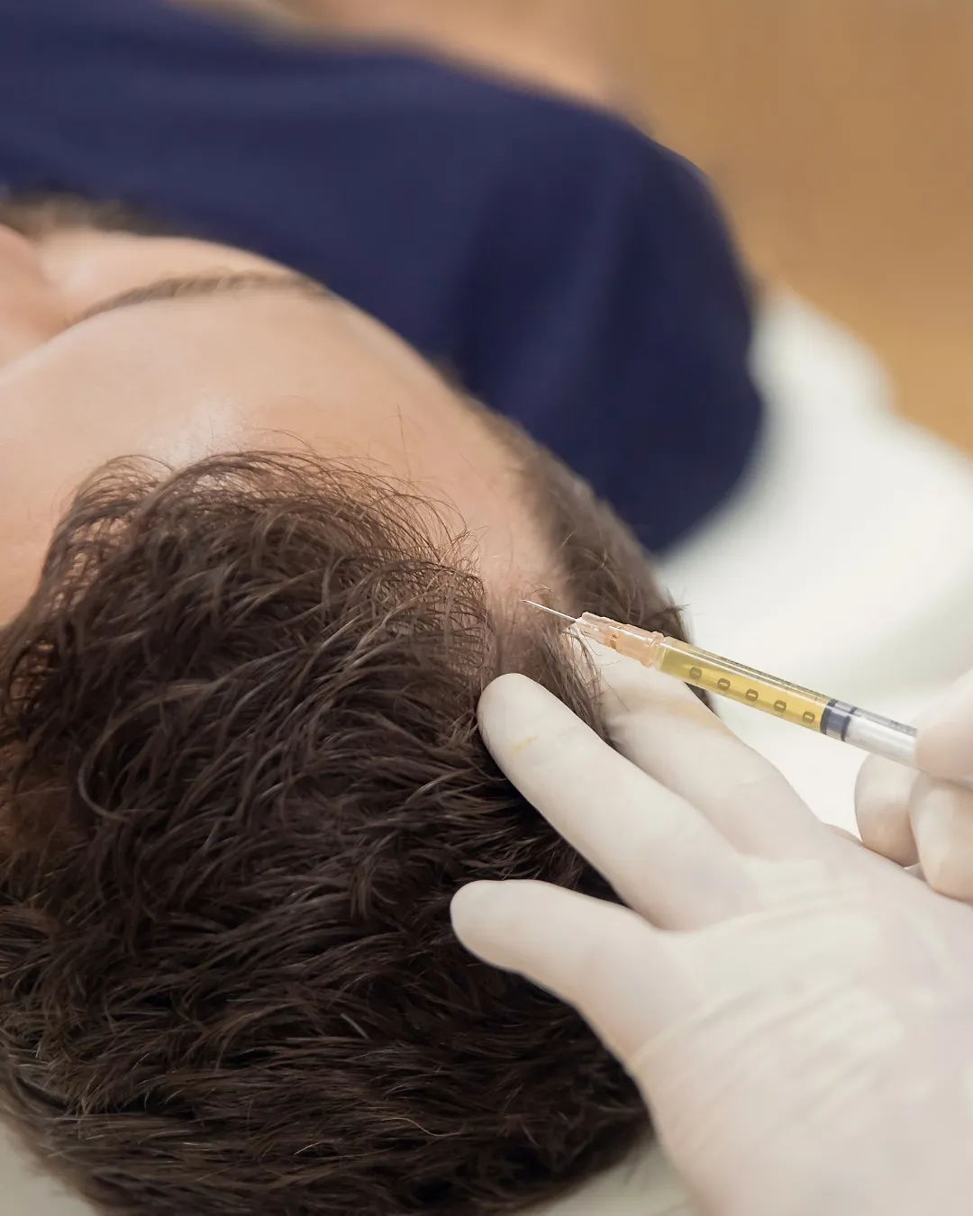 PRP-Hair-Restoration Knoxville