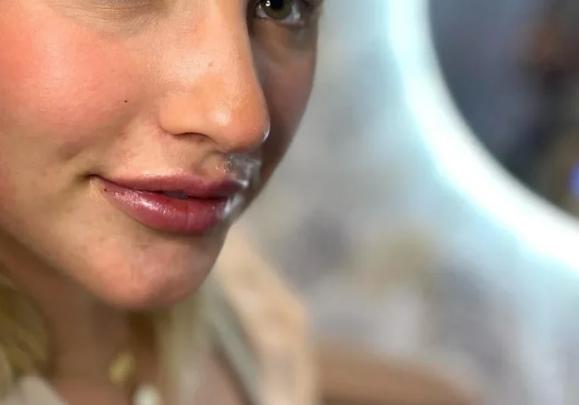 lip filler patient KNOXVILLE